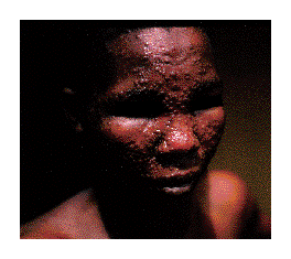 smallpox-face.gif