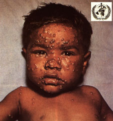 smallpox4.jpg