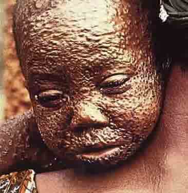 smallpox_child.jpg